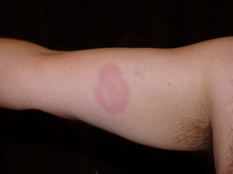 An example of the typical target like tick bite indicating Lyme disease
