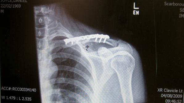 Clavicle injuries are common among cyclists